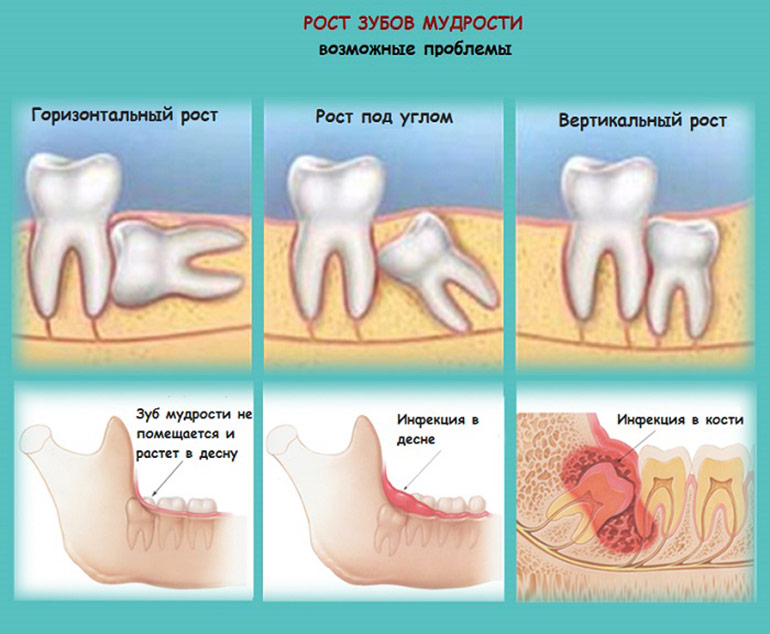 В каких случаях удаляют зуб мудрости ?